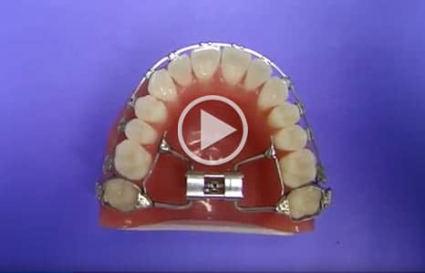 Palatal Expander Kadan Orthodontics in Doylestown, Chalfont, Harleysville PA