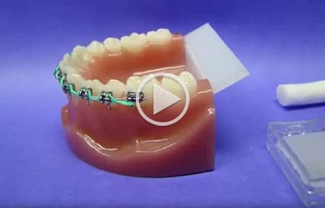 Poking Wire Kadan Orthodontics in Doylestown, Chalfont, Harleysville PA